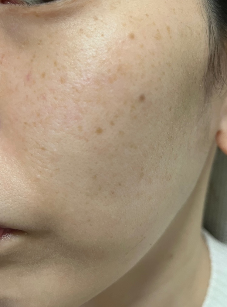 IPL（光治療）全顔2周 ｜ステラM22フォトフェイシャル【12月29日迄にご