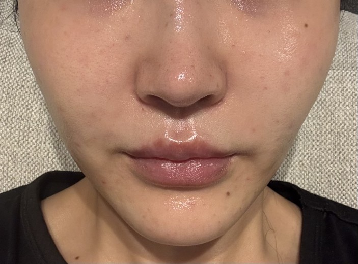 after photo: ジュベルック(Juvelook)