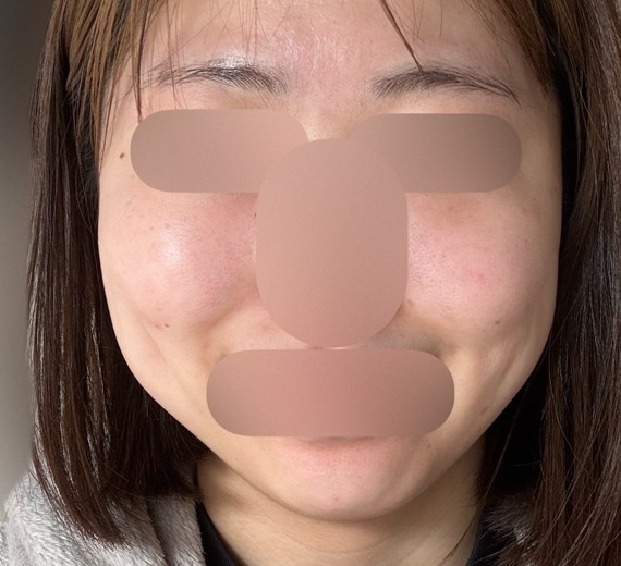 after photo: 白玉注射・点滴