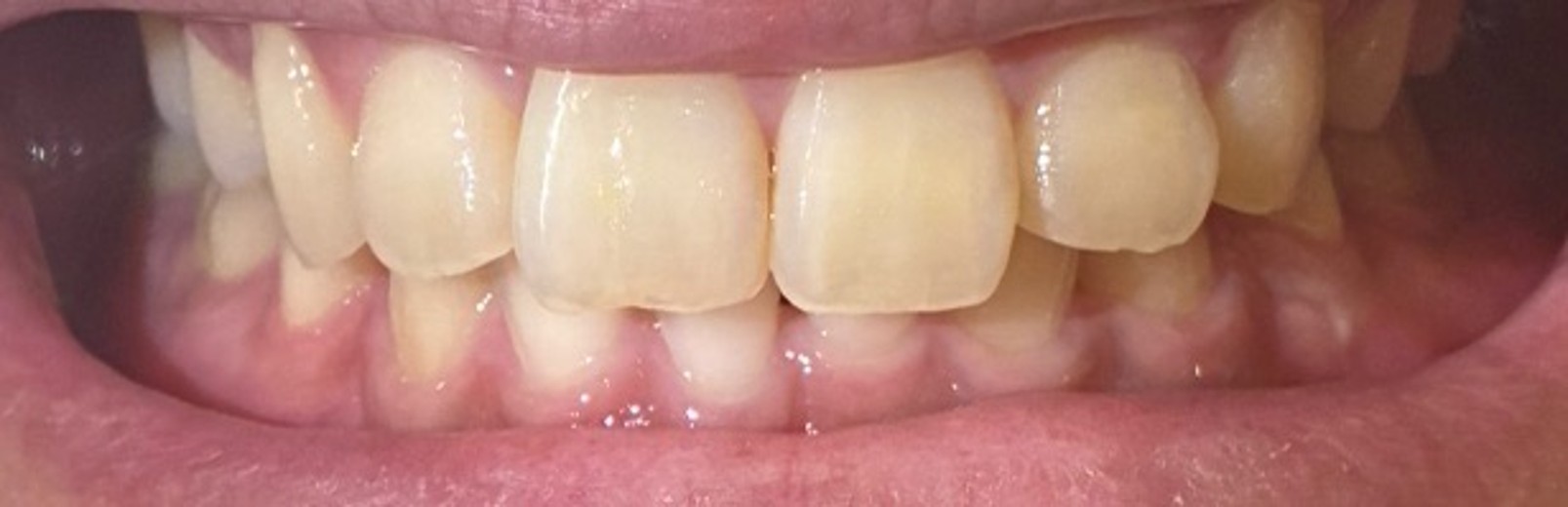 after photo: ホワイトニング