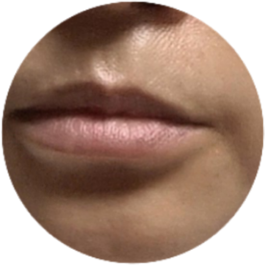 before photo: 입술필러