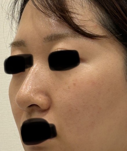 before photo: フラクショナルレーザー, エレクトロポレーション