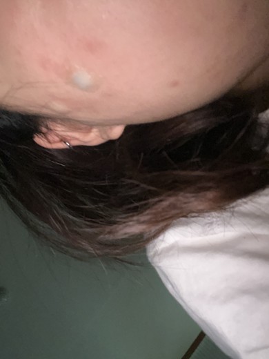 after photo: 여드름주사