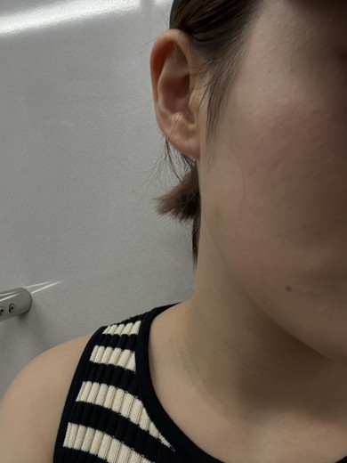 before photo: ジュベルック(Juvelook)