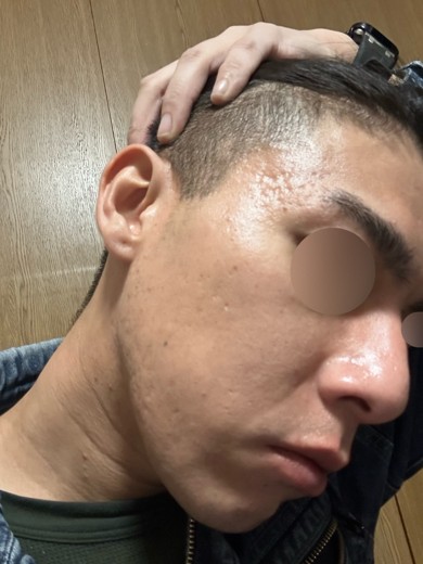 before photo: ダーマペン, エクソソーム