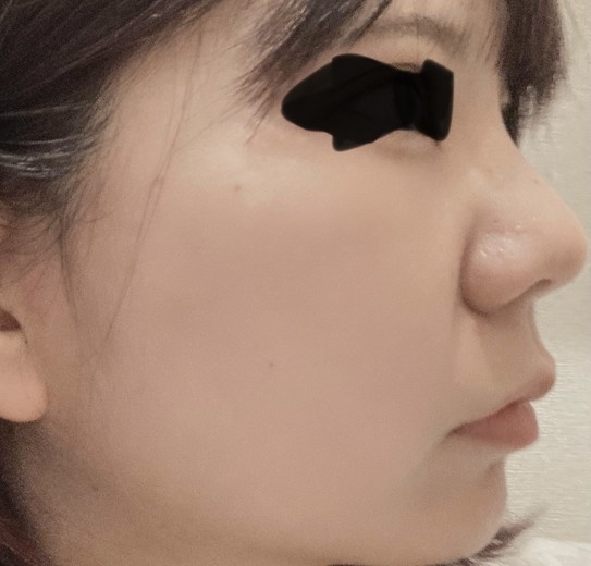 after photo: 糸リフト