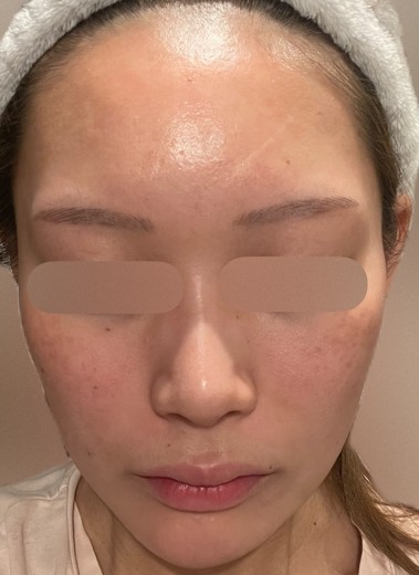after photo: ジュベルック(Juvelook), サブシジョン(ニキビ跡治療)