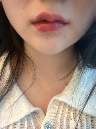 after photo: 입꼬리필러, 입술필러