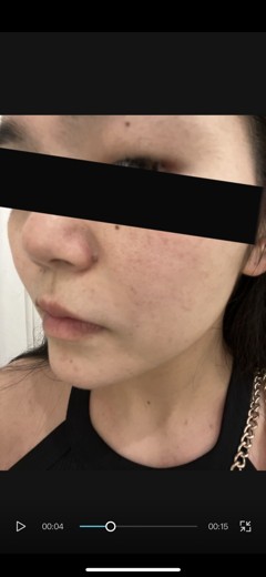 before photo: ヴェルベットスキン