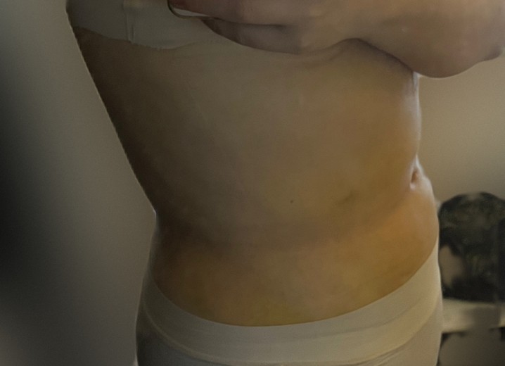 after photo: 복부지방흡입