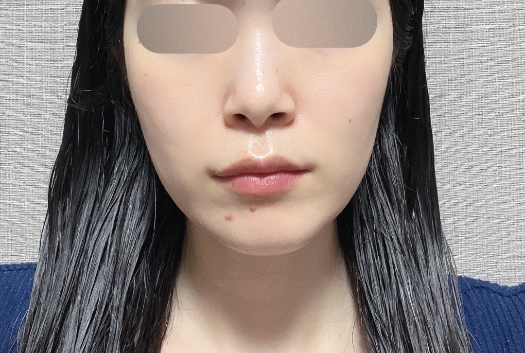 10月31日迄のご予約で初診料0円】全顔シミ取り放題＋美顔