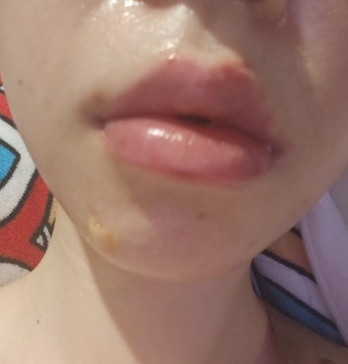 after photo: 입술필러