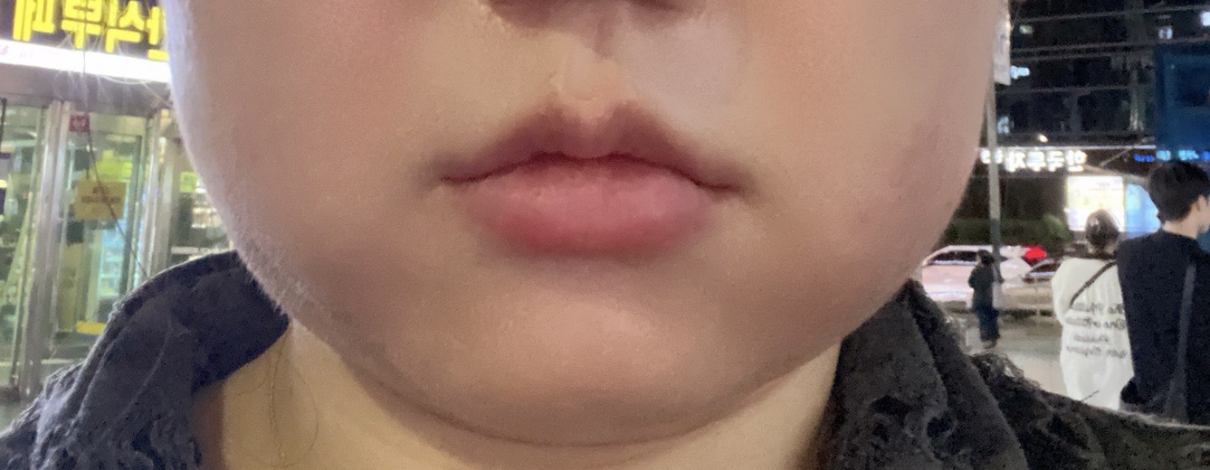 after photo: 윤곽주사, 얼굴지방분해주사