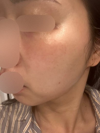 after photo: 白玉注射・点滴, ルメッカ