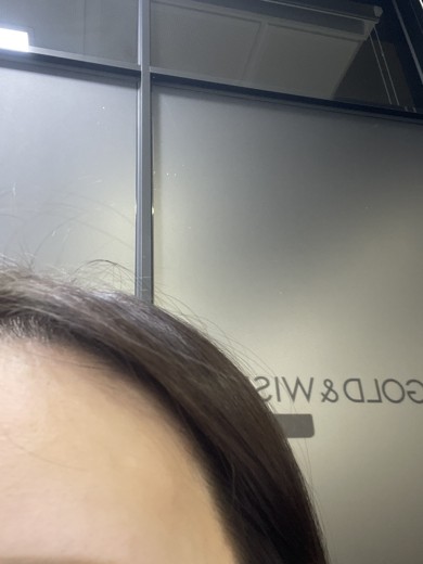 after photo: 여드름압출