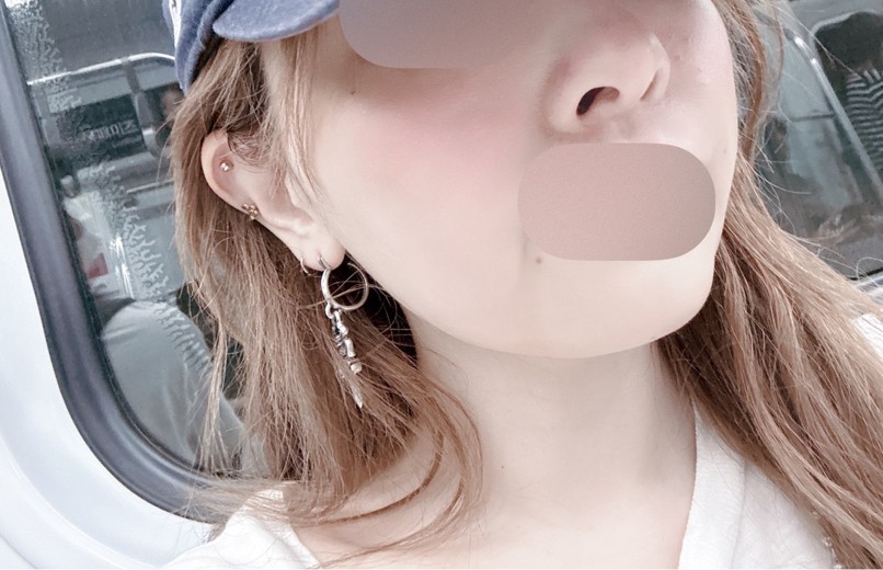 after photo: スキンボトックス