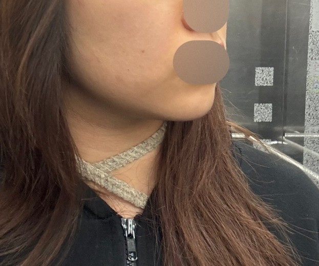 before photo: 턱끝필러