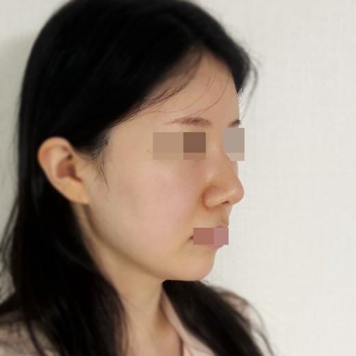after photo: 코재수술, 콧대(보형물), 복코교정(수술)