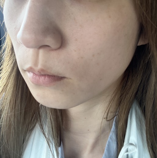 before photo: マッサージピール(コラーゲンピール)