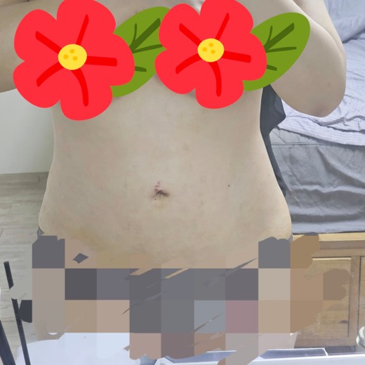 after photo: 러브핸들지방흡입, 복부지방흡입