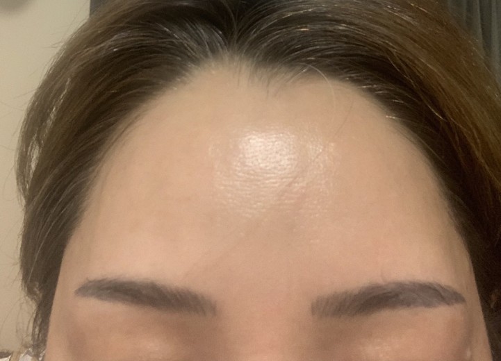 before photo: ピーリング, ルメッカ