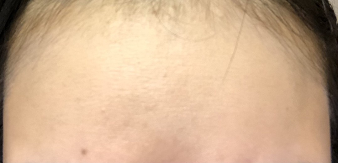 after photo: ハイドラジェントル