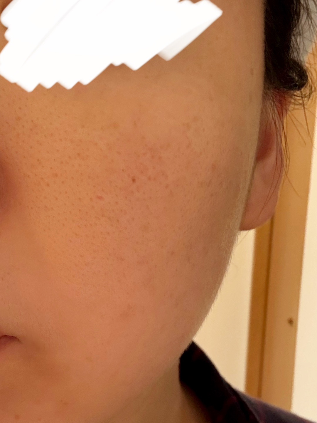 美白セット（ララピールorプラチナプラピール＋ピコダブル＋