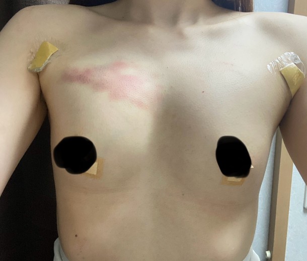 after photo: 豊胸(脂肪注入)