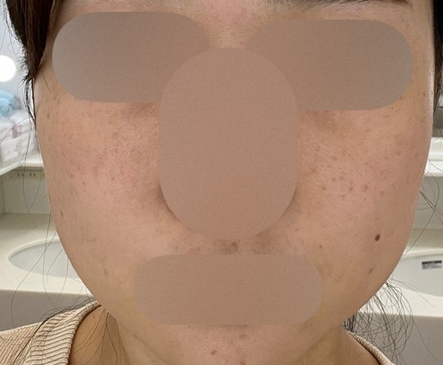 after photo: ハイドラフェイシャル