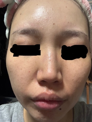 before photo: IPL(光/フォト治療)