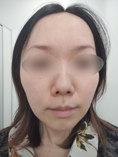 before photo: リジュランヒーラー