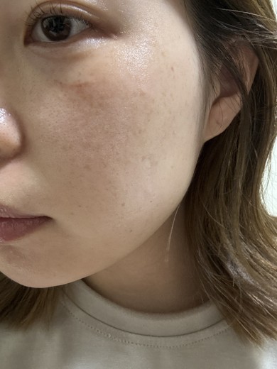 after photo: ダーマペン, エクソソーム