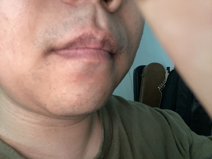 after photo: 턱제모, 인중제모