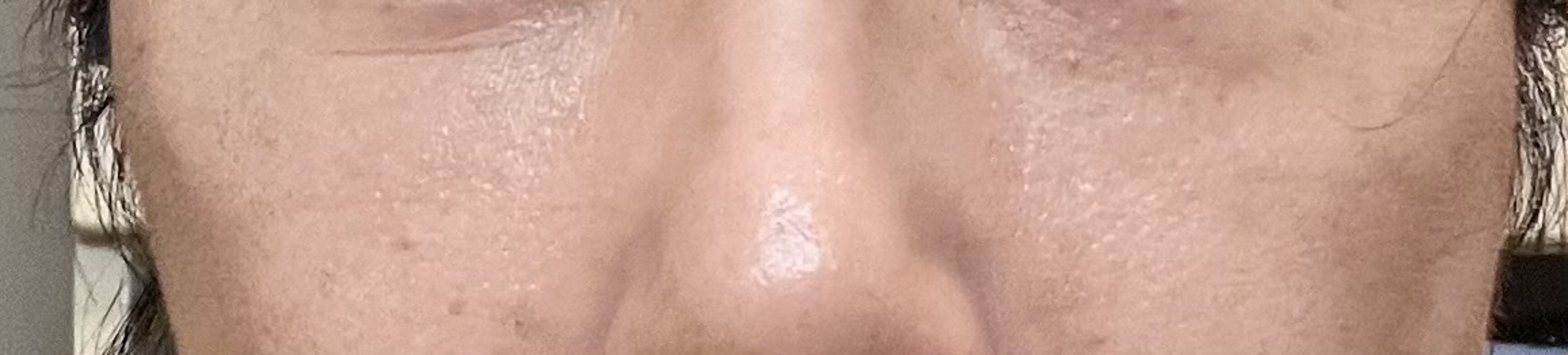 after photo: ピコトーニング, 白玉注射・点滴