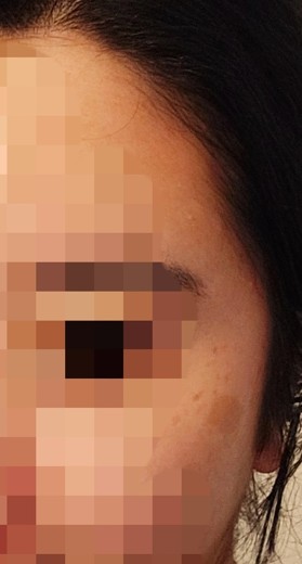 before photo: 리팟레이저