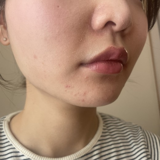 after photo: ダーマペン