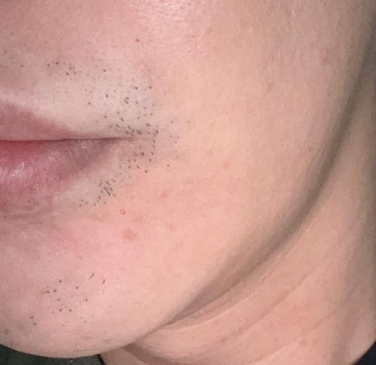 after photo: 인중제모