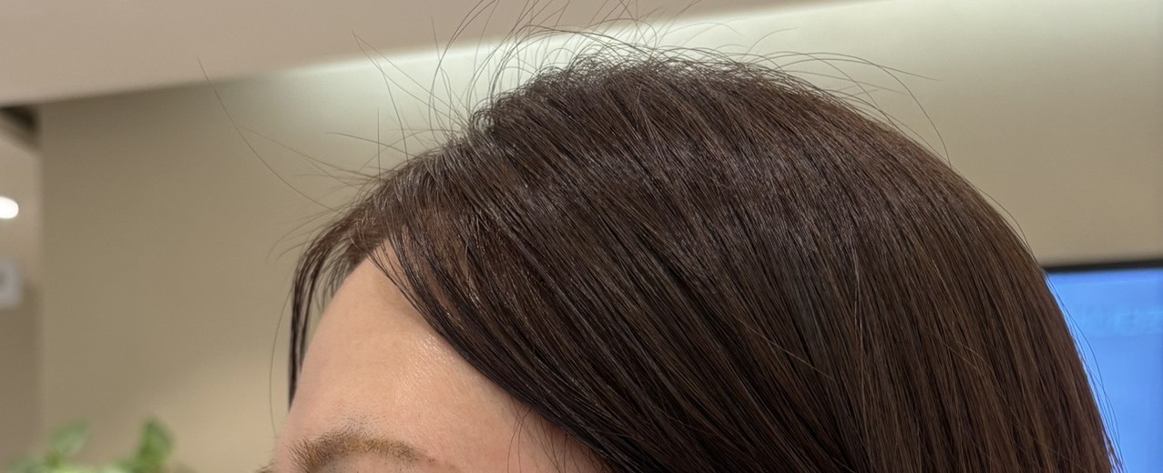 before photo: 이마필러