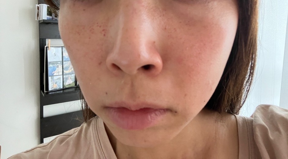 after photo: ピコトーニング, ピコフラクショナル