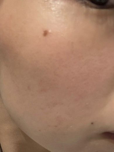 after photo: IPL(光/フォト治療), ルメッカ