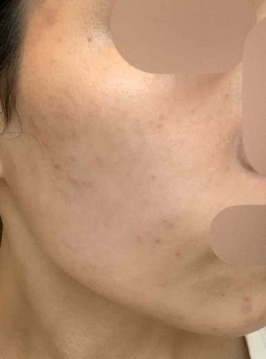after photo: IPL(光/フォト治療), ルメッカ