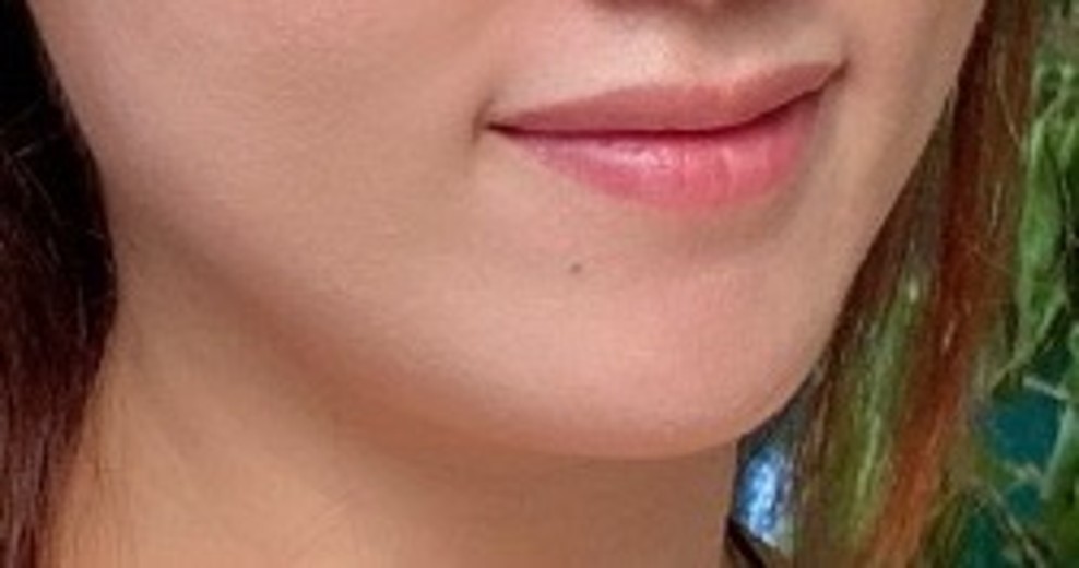 after photo: 슈링크리프팅