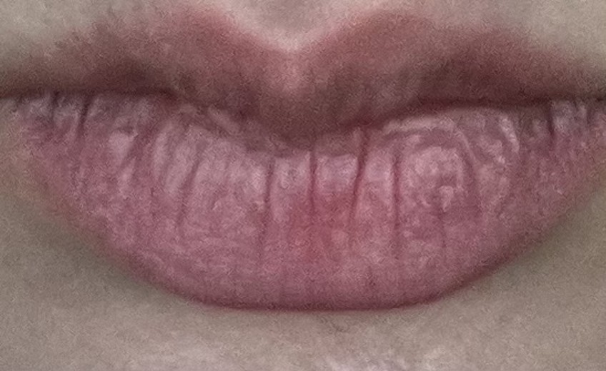 before photo: 입술필러