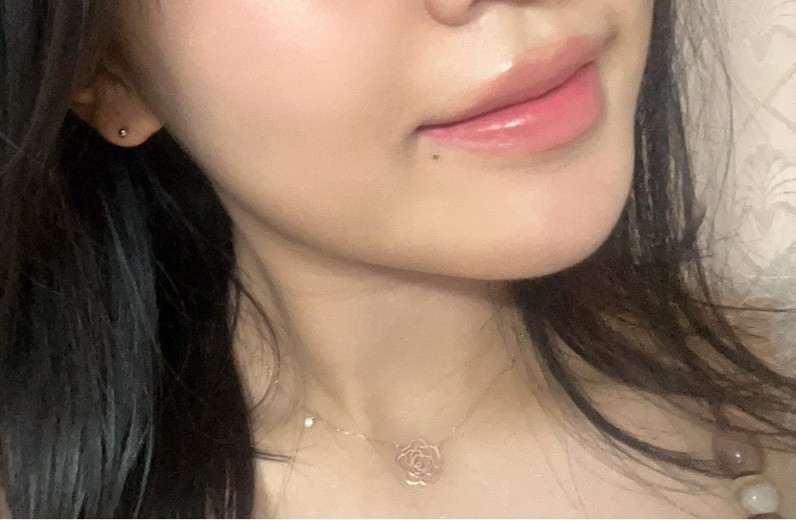 after photo: 윤곽주사