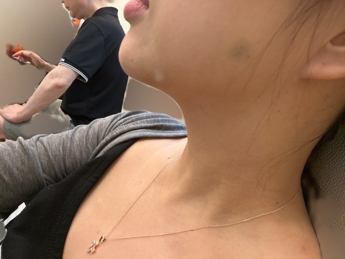 after photo: 침샘보톡스