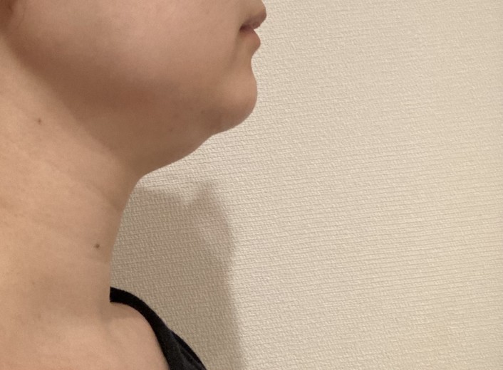 after photo: 脂肪溶解注射(顔)