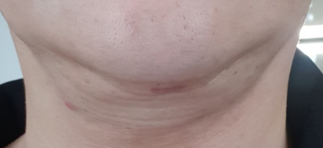 after photo: 이중턱지방흡입, 이중턱근육묶기