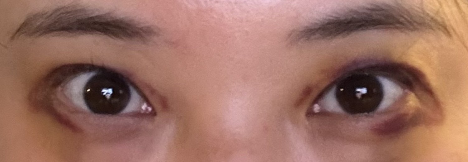 after photo: 눈재수술, 눈매교정