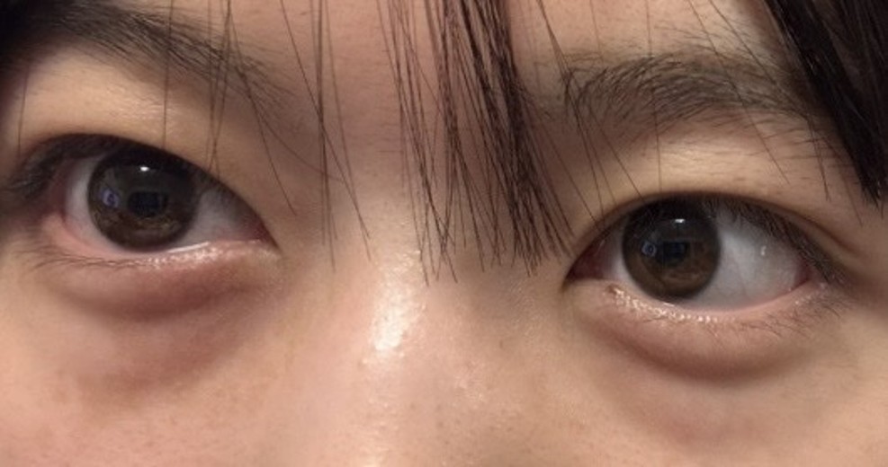before photo: 目の下脂肪再配置(ハムラ・裏ハムラ法)