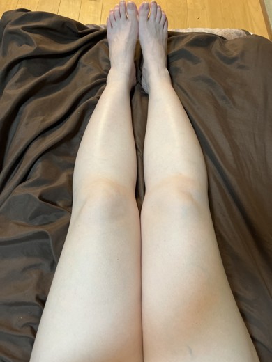 after photo: 脂肪溶解注射(太もも)